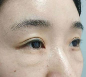 眼袋手术