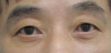 眼袋手术