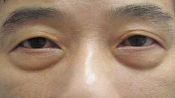 眼袋手术