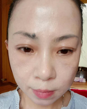 眼袋手术