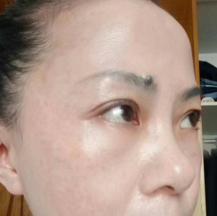 眼袋手术
