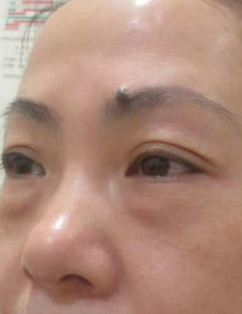 眼袋手术