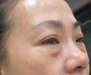 眼袋手术