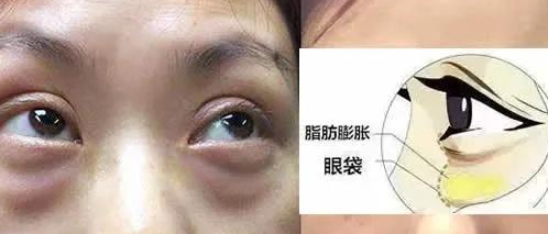 眼袋手术