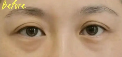 眼袋手术