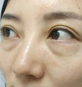 眼袋手术