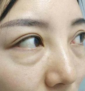 眼袋手术
