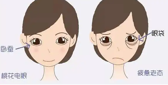 眼袋手术