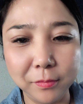 眼袋