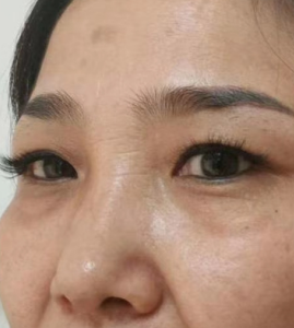 眼袋