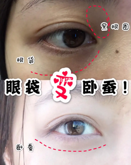 眼袋