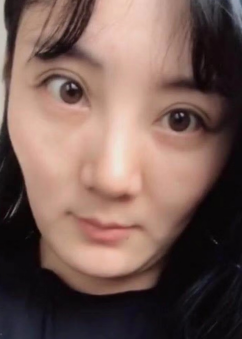 眼袋手术