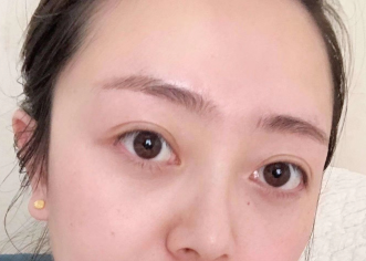 眼袋手术