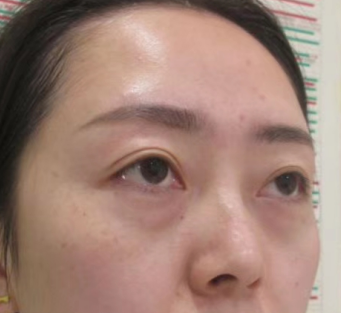 眼袋手术