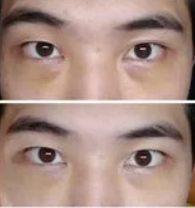 眼袋手术