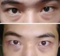 眼袋手术