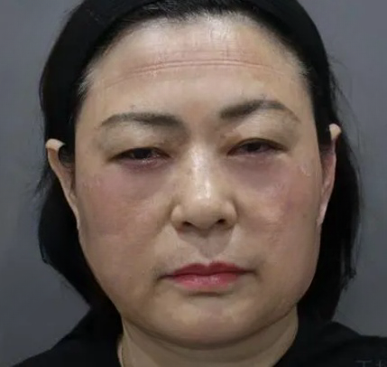 去眼袋手术