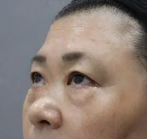 去眼袋手术