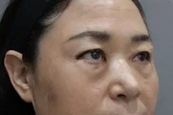 去眼袋手术