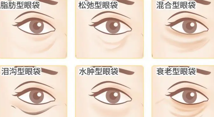 去眼袋手术