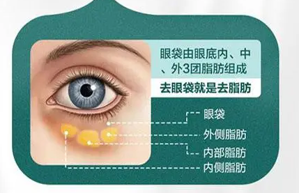 去眼袋手术