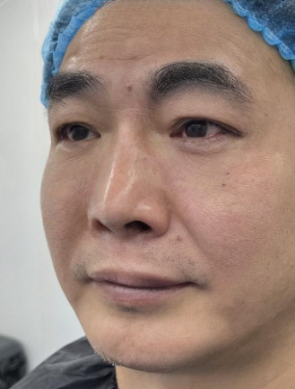 去眼袋手术