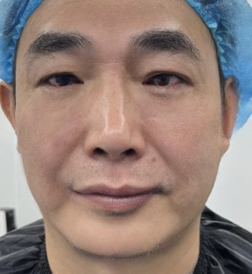 去眼袋手术