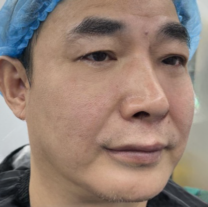 去眼袋手术