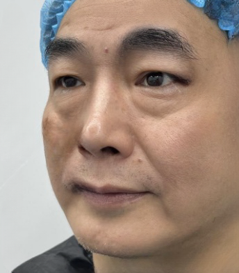 去眼袋手术