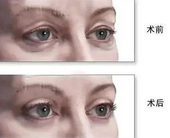 去眼袋手术