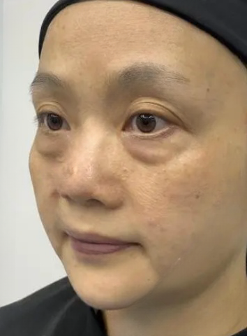 去眼袋手术