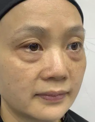 去眼袋手术