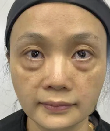 去眼袋手术