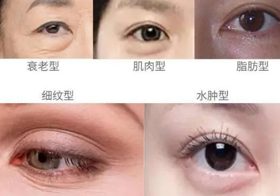 去眼袋手术