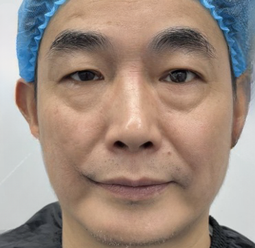 去眼袋手术
