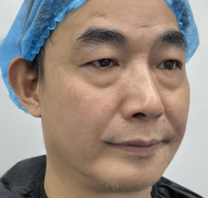 去眼袋手术