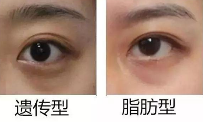去眼袋手术