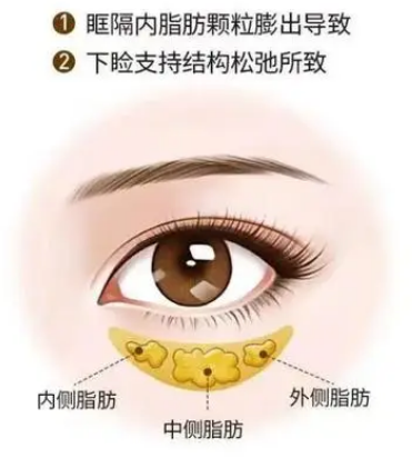 去眼袋手术