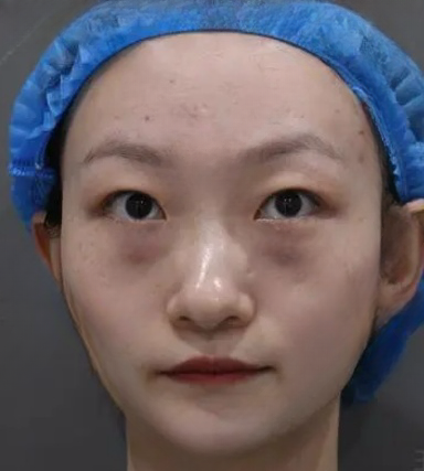 去眼袋手术
