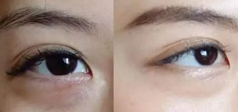 眼袋