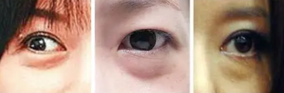 眼袋
