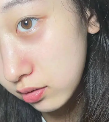 眼袋