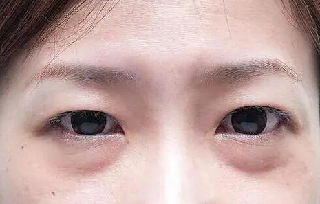 眼袋