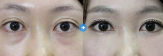 眼袋