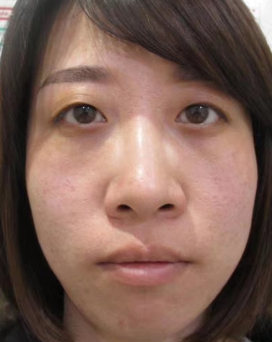 眼袋