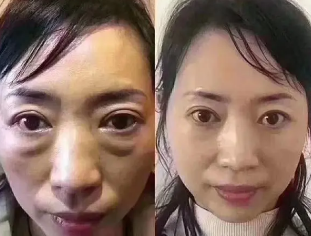 眼袋