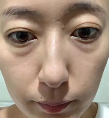 眼袋