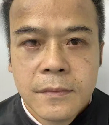 去眼袋手术