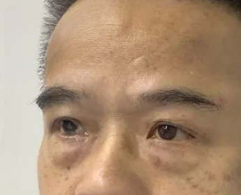 去眼袋手术