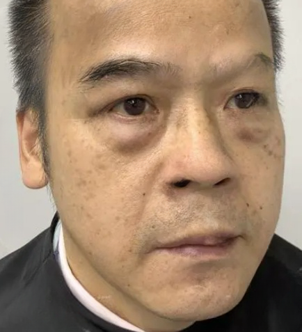 去眼袋手术